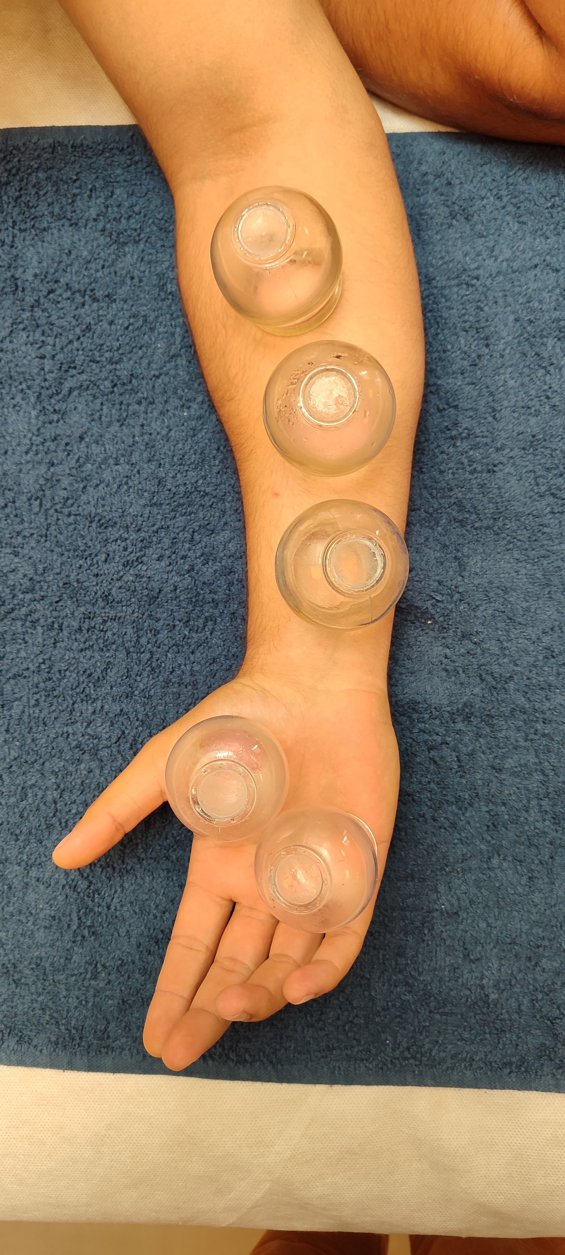 Ventouses sur le bras